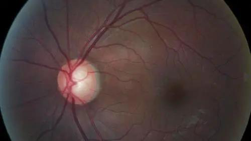 青光眼的克星来袭，，，，，助力患者远离视力的“窃贼”